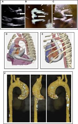 Intervention for critical aortic stenosis in Hutchinson-Gilford progeria syndrome